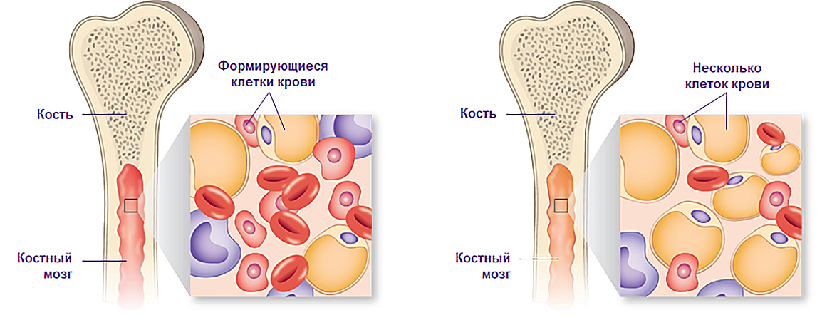 Здоровый (слева) и апластический костный мозг (справа)