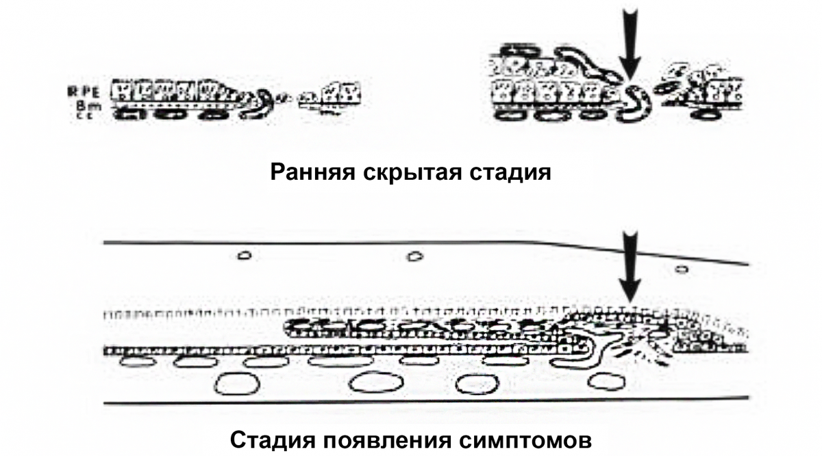 ХНВ 2 типа: черные стрелки показывают рост новых капилляров из хориокапилляров через дефект в локально поврежденной мембране Бруха в пространство под нейроэпителием вдоль участка пролиферирующего   