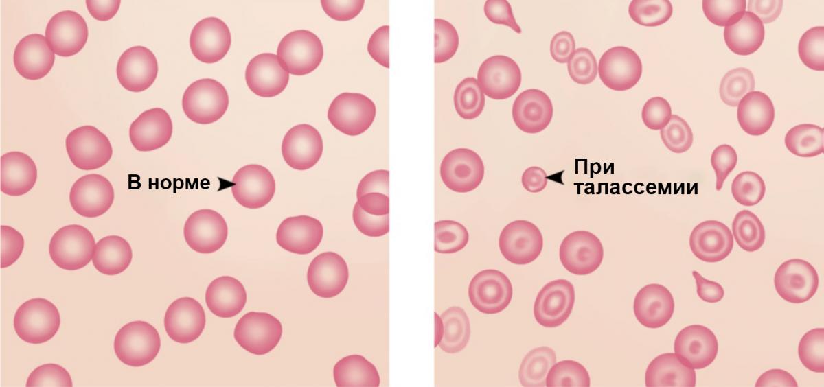 Рисунок 3. Эритроциты в норме и при талассемии