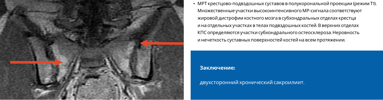  МРТ крестцово-подвздошных суставов