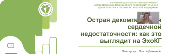ОДСН на ЭхоКГ