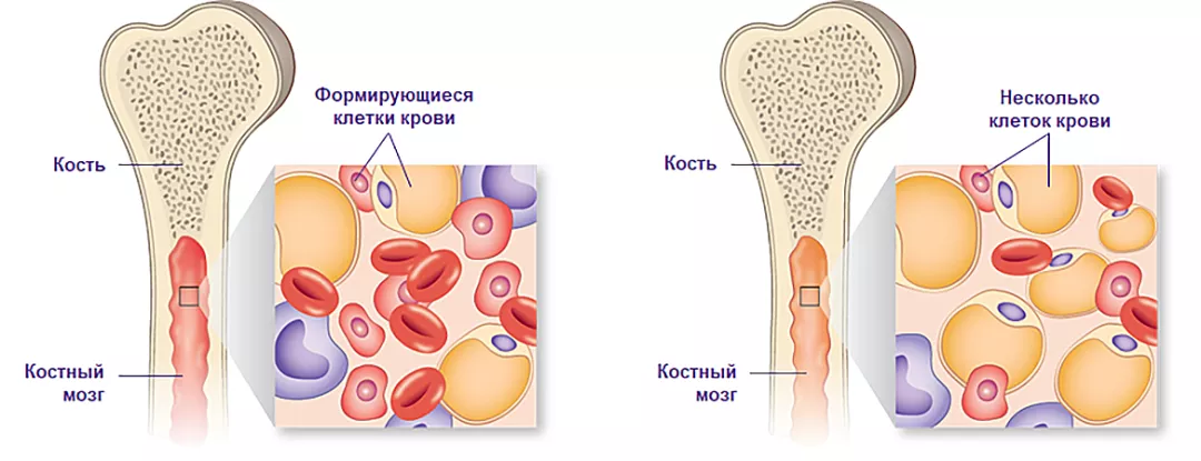 Здоровый (слева) и апластический костный мозг (справа)